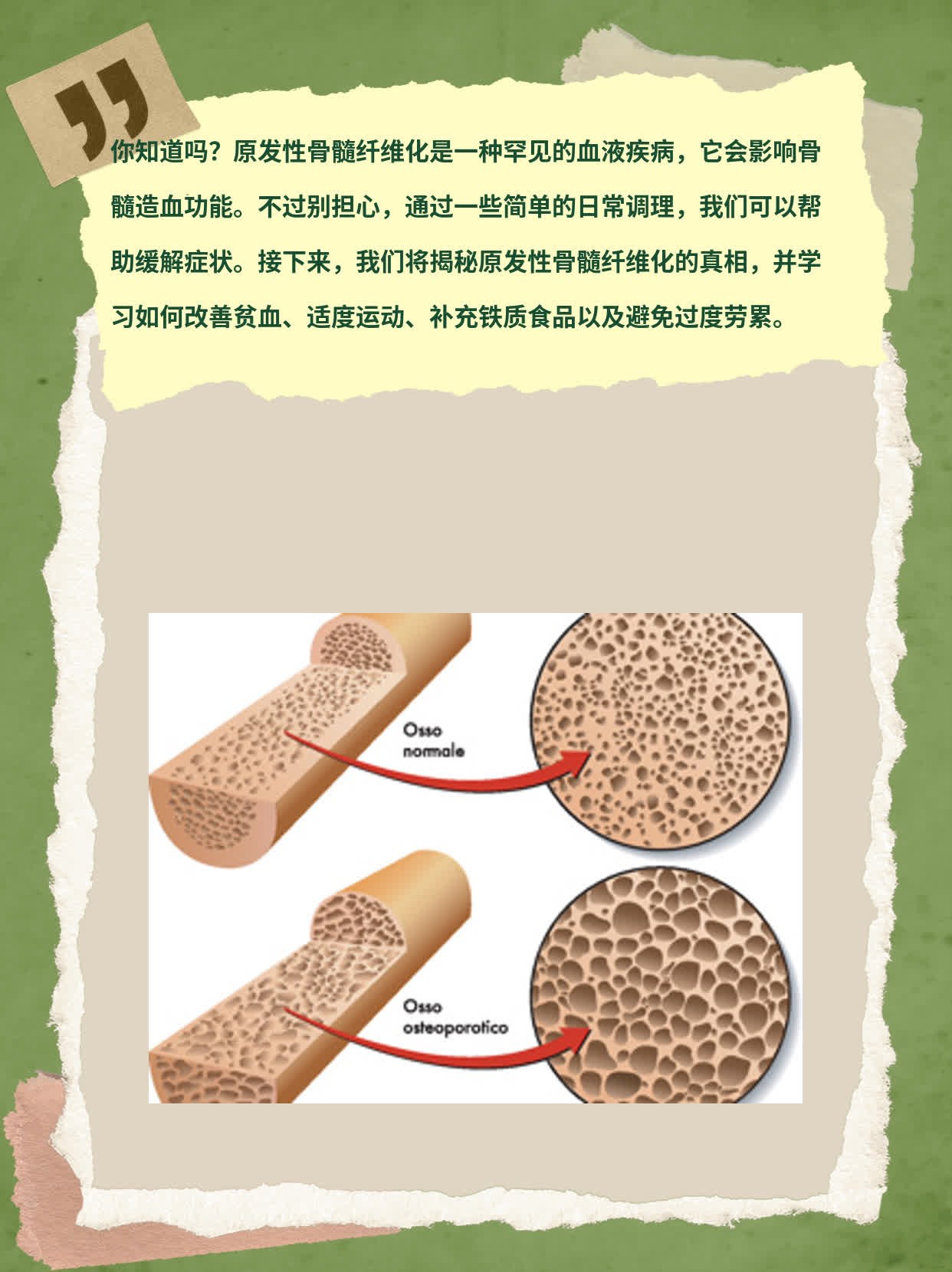 骨髓纤维化最新疗法，探索与突破